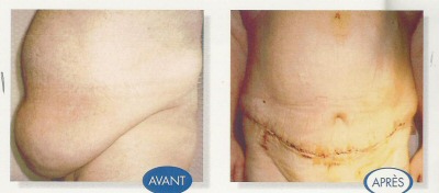 tummy tuck before and after 2
