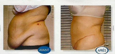 tummy tuck before and after 2